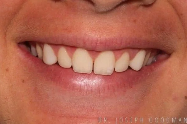 Veneers before picture