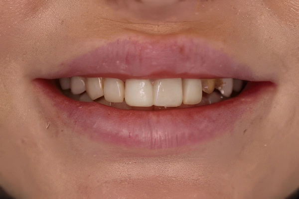 veneers-uneven-teeth-before