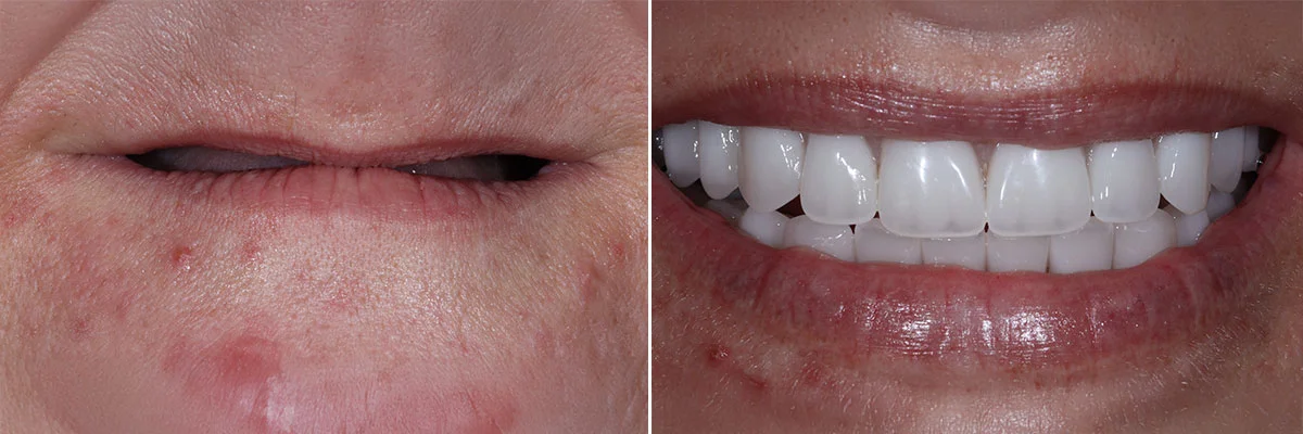 Mouth Rejuvenation