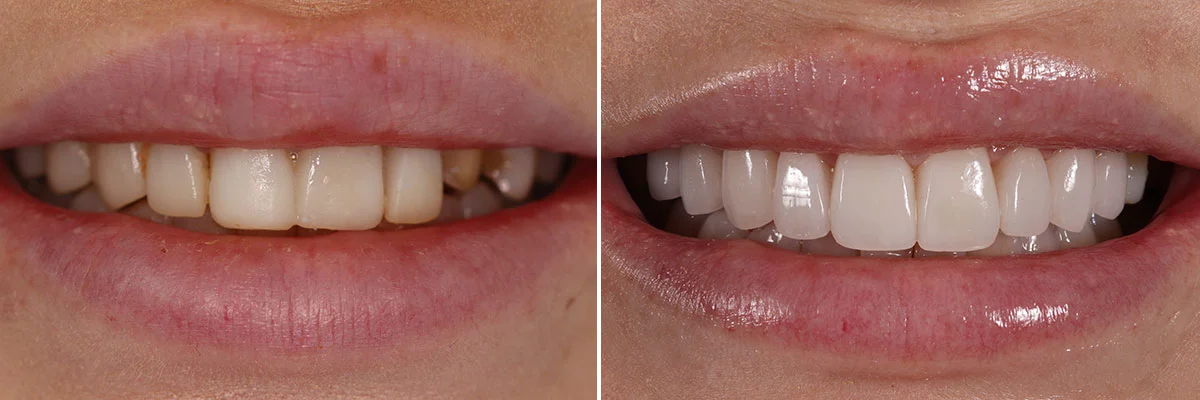 natural-smile-veneers