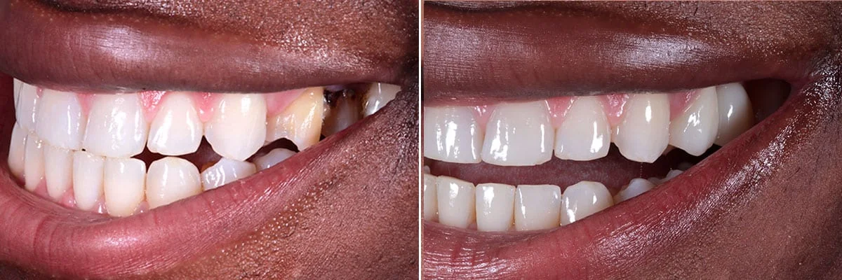 invisalign beverly hills ca