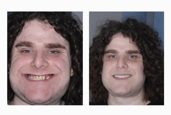 FACE Dentistry patient in Beverly Hills, before and after, showing jawline and chin position changes without jaw surgery