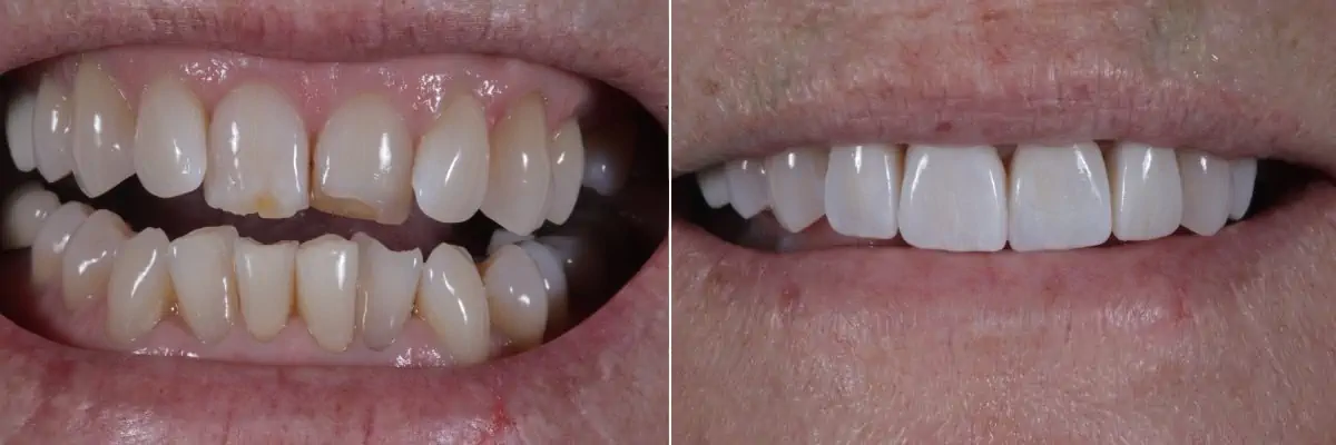 before-after_4-porcelain-veneers 5