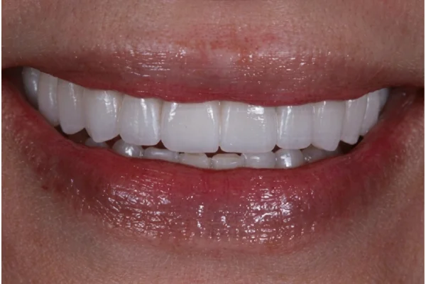 bite correction beverly hills after