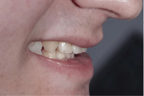 bite correction face dentistry beverly hills after
