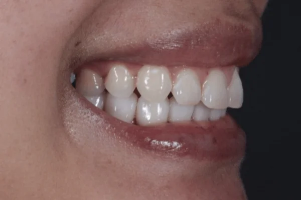 bite correction Dr. Joseph Goodman DDS