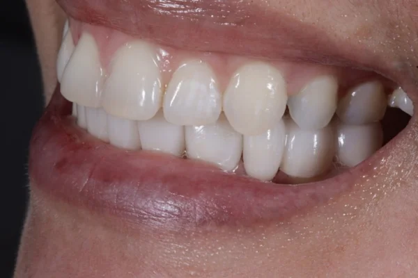 bite correction Beverly hills ca Dr. Joseph Goodman DDS