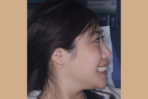 bite correction face dentistry beverly hills after