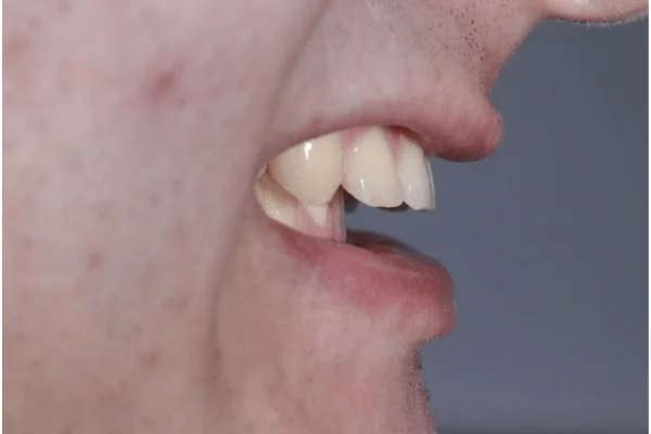 bite correction face dentistry beverly hills before
