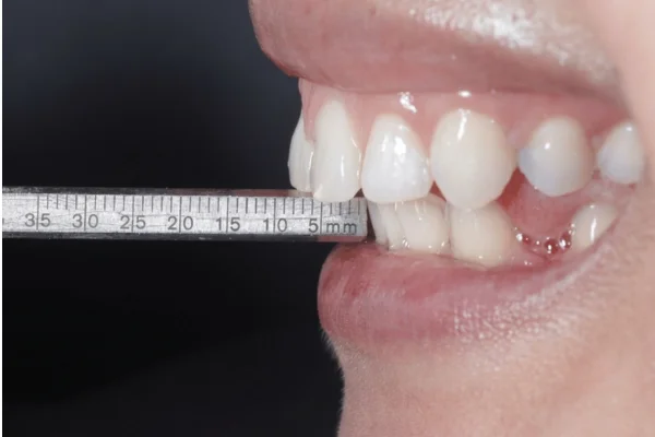 bite correction Dr. Joseph Goodman DDS