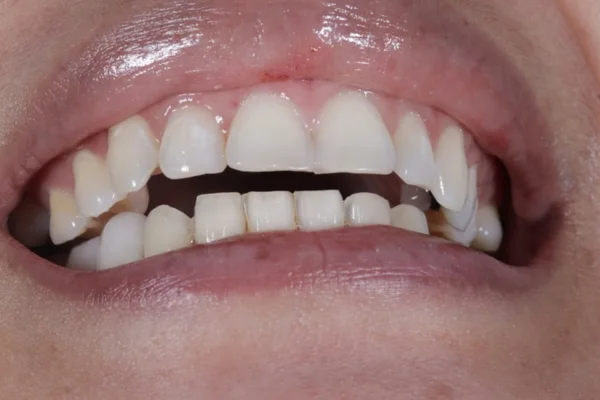 bite correction Beverly hills ca Dr. Joseph Goodman DDS