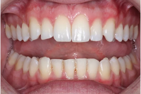 dr goodman invisalign before