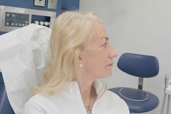 face-dentistry after in beverly hills