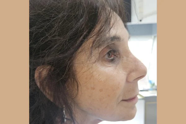 face-dentistry after in beverly hills