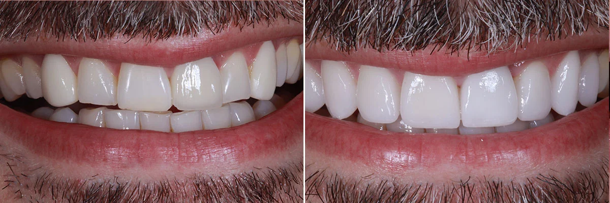 grinder-worn-uneven-teeth 18