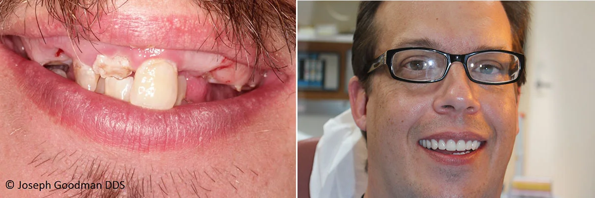makeover-with-implants-crowns 15