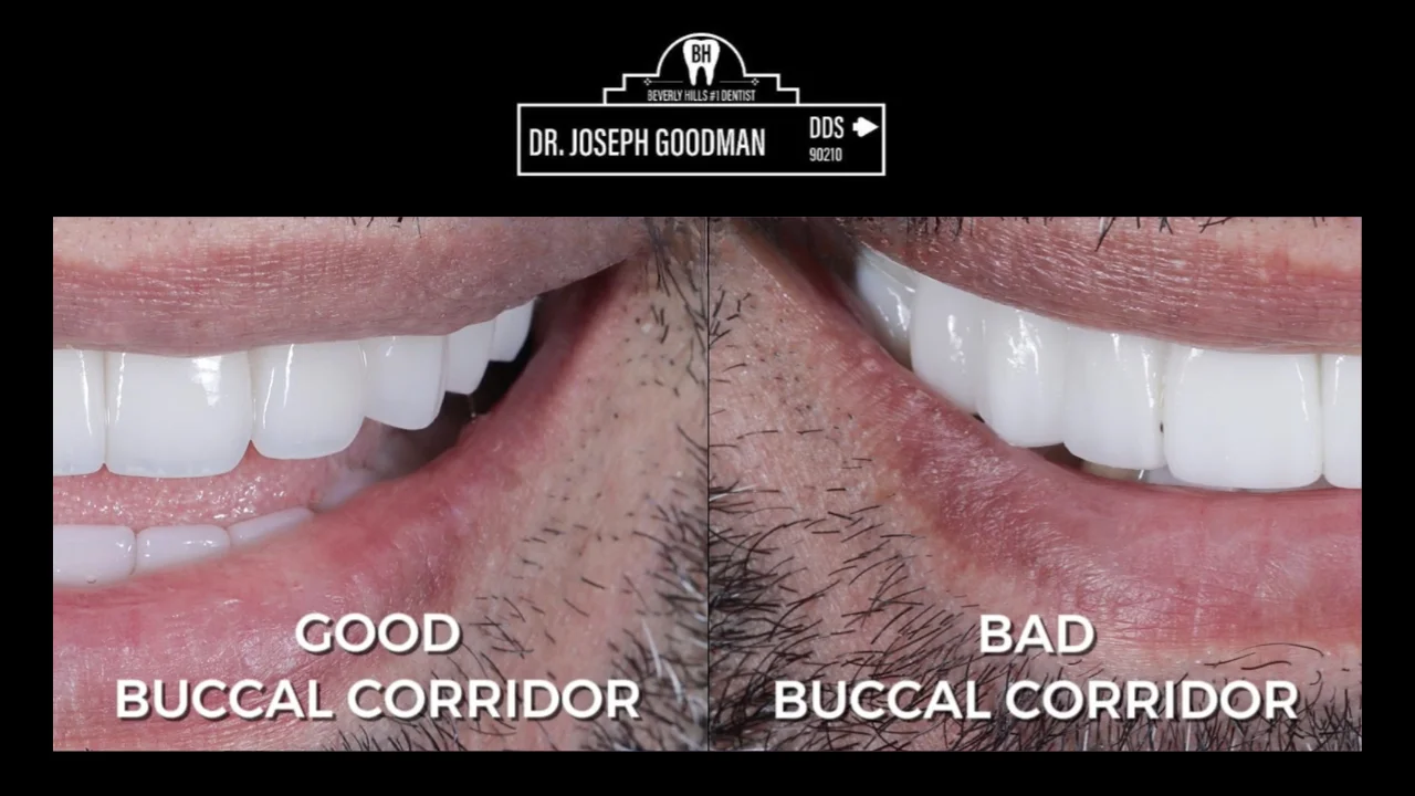 Dr. Joseph Goodman DDS porcelain veneers