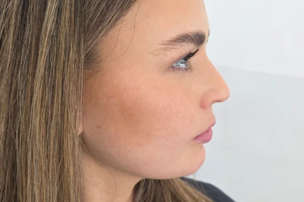 Class 2 Correction, Recessed and Concave Chin after in beverly hills ca