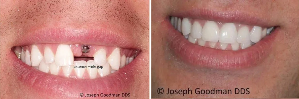 dental implants beverly hills ca, Dr. Joseph Goodman DDS
