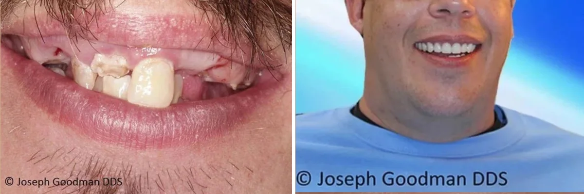 dental implants beverly hills ca, Dr. Joseph Goodman DDS