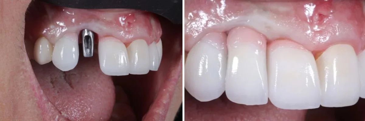 dental implants beverly hills ca, Dr. Joseph Goodman DDS
