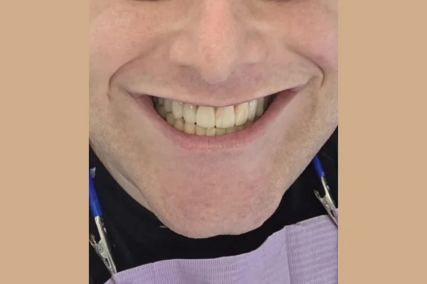 Face dentistry beverly hills After image with Dr. Goodman DDS DMD