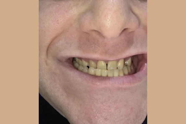 Face dentistry beverly hills before