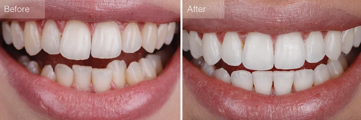 Invisalign beverly hills ca, Dr. Joseph Goodman DDS