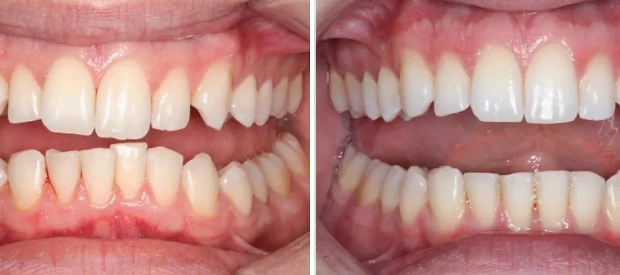 Invisalign before and after in beverly hills