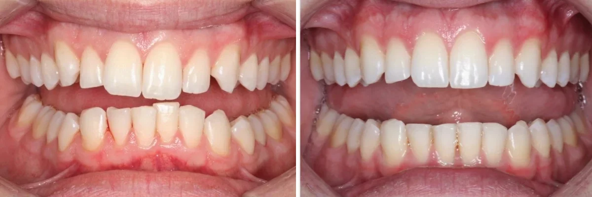 Invisalign before and after in beverly hills