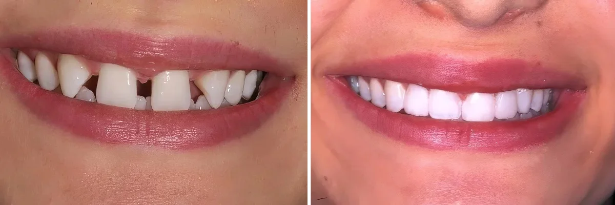 Invisalign before and after in beverly hills