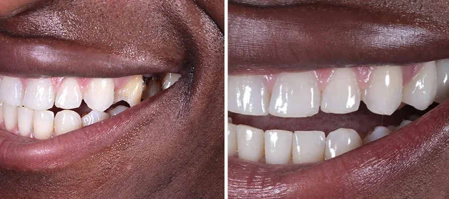 Invisalign before and after in beverly hills