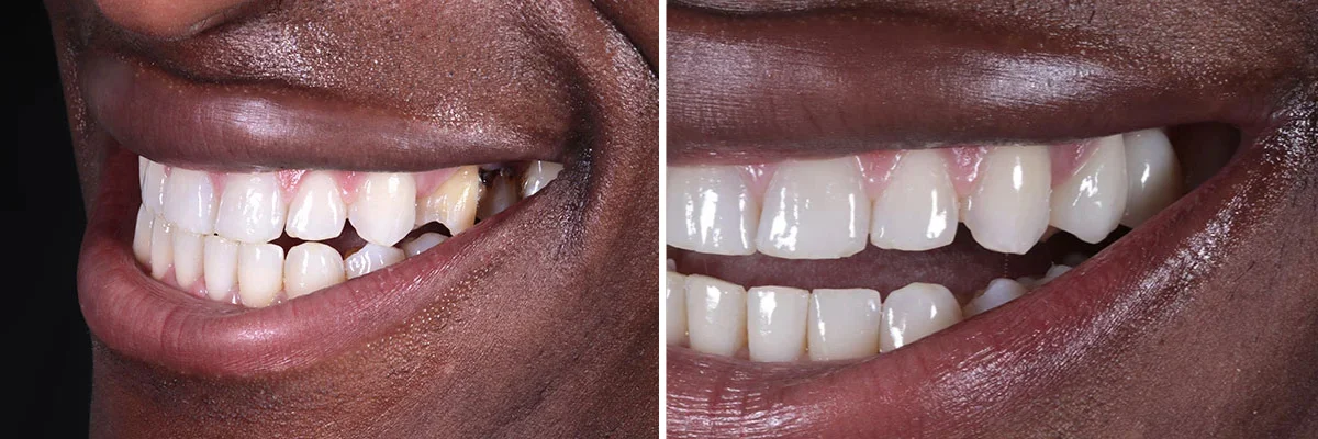 Invisalign before and after in beverly hills