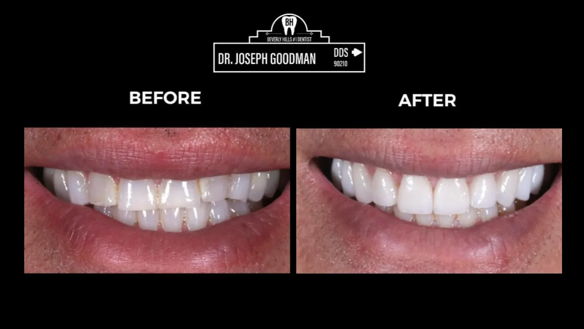 Veneers treatment video covers in beverly hills
