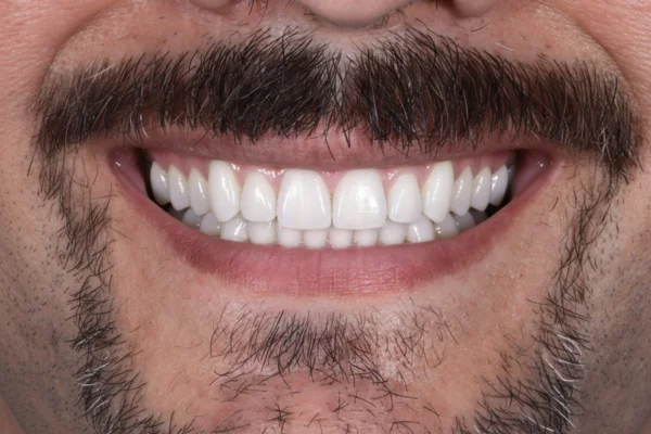 class 3 cross bite beverly hills after with Dr. Joseph Goodman