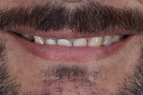 class 3 cross bite beverly hills before image