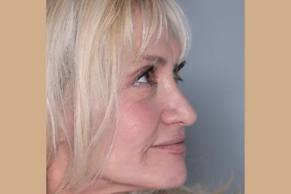 face dentistry beverly hills after image with Dr. Joseph Goodman dds dmd