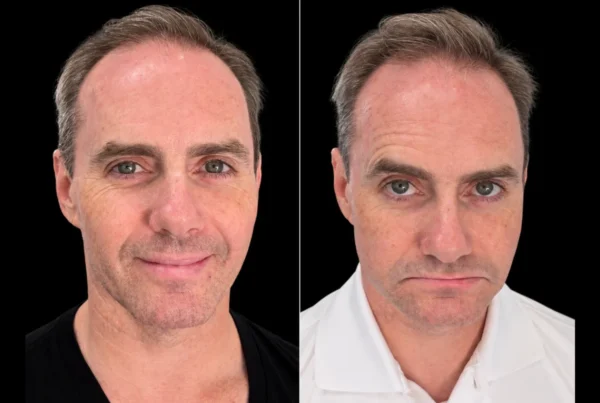 Non-Surgical Crossbite Correction in Beverly Hills. Front view before and after FACE Dentistry in Beverly Hills, comparing lower face height and lip position