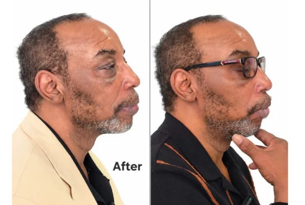 Side profile before and after FACE Dentistry in Beverly Hills, showing chin and jawline position without jaw surgery