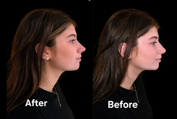 Small chin? Side profile before and after FACE Dentistry in Beverly Hills, showing chin projection and jawline without a chin implant