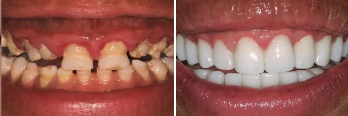 teeth whitening dentist beverly hills ca, Dr. Joseph Goodman DDS
