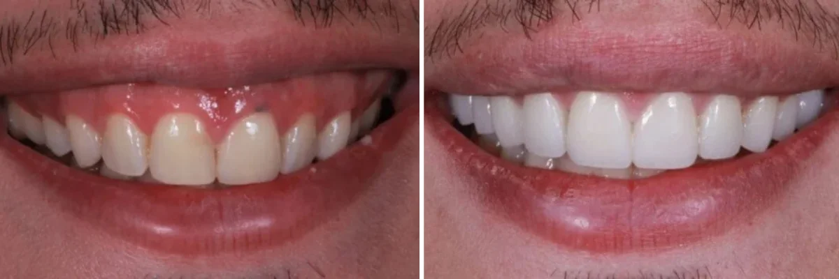 teeth whitening dentist beverly hills Dr. Goodman DDS
