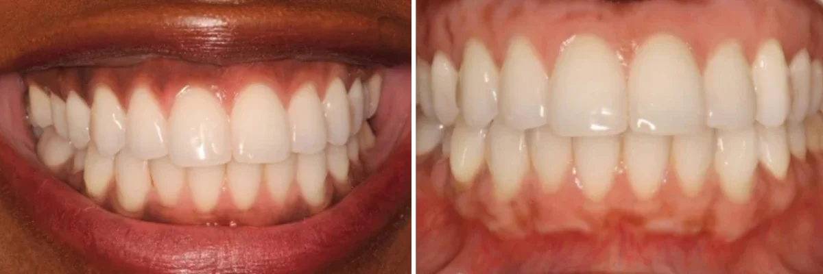 teeth whitening dentist beverly hills