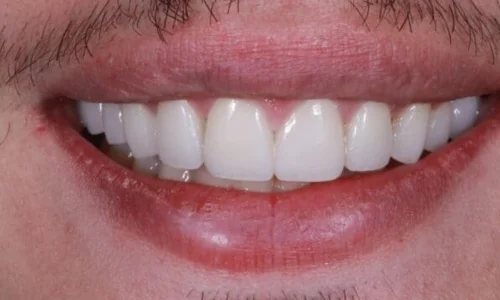 gum-bleaching and teeth whitening after