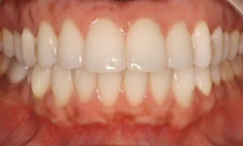 gum-bleaching and teeth whitening after