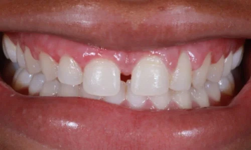 gum-bleaching and teeth whitening after