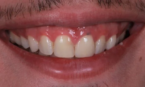 gum-bleaching and teeth whitening before
