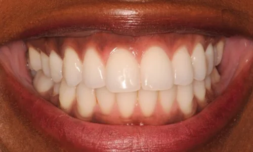 gum-bleaching and teeth whitening before