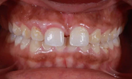 gum-bleaching and teeth whitening before