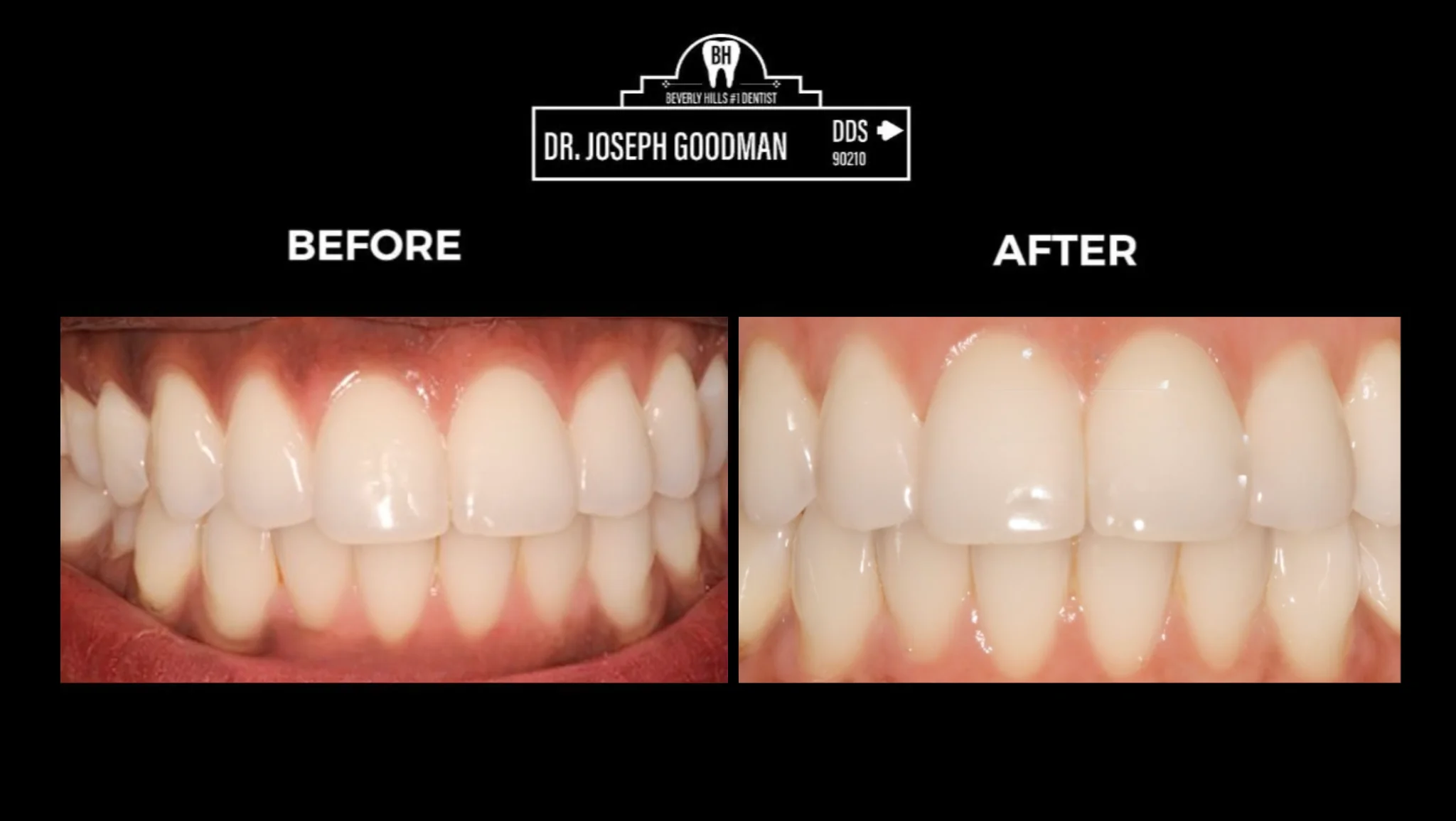 gum bleaching beverly hills ca
